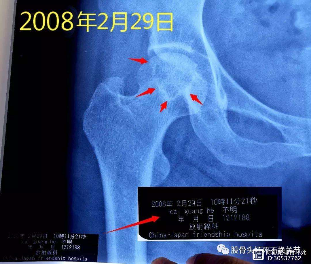 金华人工骨头医保报销多少(人工骨头医保报销多少比例)